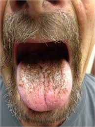 Image result for black hairy tongue symptoms