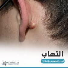 ما هي أسباب التهاب الغدد اللمفاوية بالعربيك