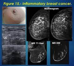What are the symptoms, and how is it diagnosed and treated? Epos