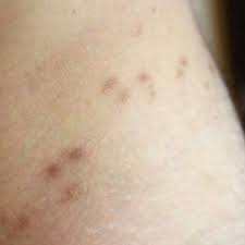 Wir untersuchten topisches permethrin, topisches ivermectin und systemisches ivermectin zur behandlung von krätze bei frauen und männern jeden alters. Kratze Ist Zuruck Ansteckung Ursache Behandlung Und Wie Sie Die Hautkrankheit Erkennen Gesundheit