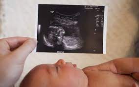 You won't get any results at the time of the scan. Ultrasound Accuracy For Predicting Due Dates