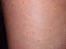 Symptoms and signs of west nile virus include fever, headache, body aches, skin rash, and swollen lymph nodes. Image Iq End Of Summer Trip And A Widespread Rash