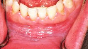 Image result for gums cancer symptoms