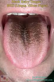 Image result for brown tongue symptoms