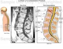 Sustained l1 compression fracture %20. Lumbar L1 Compression Fracture Medical Illustration Human Anatomy Drawing Anatomy Illustration