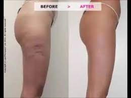 Finally i got rid of my cellulite. What Gets Rid Of Cellulite On The Bum And Thighs How Long Does It Take To Lose Cellulite On Thighs Youtube