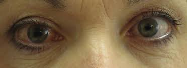 The nottingham family glaucoma screening study / br. Glaucoma