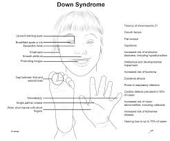 Epicanthal fold, epicanthus, eye fold,3 mongolian fold,4 palpebronasal fold5. Chromosomal Diseases Biochemistry Medbullets Step 1