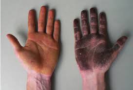 Image result for Anhidrosis