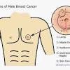Determine potential signs of male breast cancer. 1
