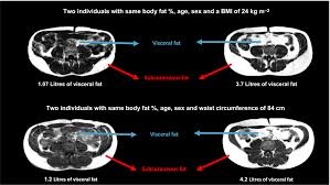 Ethnic Differences In Adiposity And Diabetes Risk Insights From Genetic Studies Yaghootkar 2020 Journal Of Internal Medicine Wiley Online Library