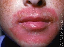 Image result for dermatitis contacta children