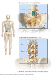 A lower back spasm usually feels like a muscle is firmly contracting or moving. Spinal Fusion Mayo Clinic