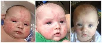 A Doctor Recommended Using Aveeno Baby Lotion To Get Rid Of This Rash It Didn T Work Then A Seacret Agent Recommended Usin Mud Soap Baby Lotion Aveeno Baby