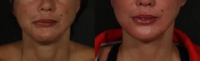 However, recovery usually begins 2 weeks to 6 months from the onset of the symptoms. Botox For Bell S Palsy Botox Injections For Facial Nerve Palsy Fpi