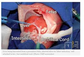 Guided by ultrasound, the abortionist grabs the baby's leg with forceps. Watch University Experiments On Aborted Baby Parts Funding Linked To Fauci News