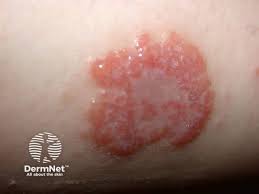 Image result for Eczema nummulare