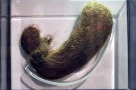 Electrolysis uses an electric current to kill the hair root. Doctors Remove Hairball From Girl S Stomach