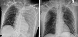 Image result for Pulmonary Contusion