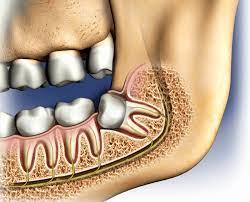 However this isn't always the case, as some never erupt at all. Removing Wisdom Teeth Healthdirect