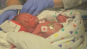 premature baby with reflux and feeding issues
