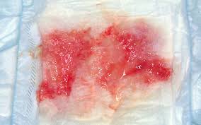 腸重積症｜子ども医学館｜妊娠・出産・育児に関する総合情報サイト【ベビカム】