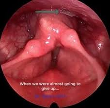 If a fish bone gets stuck in your throat, it can be painful and frightening. Fishbone In The Throat Dr Rao S Ent Super Speciality International Hospital