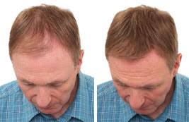 The best hair loss concealers are easy to use and transport, are instantly effective and blend seamlessly. Fibers24 Couvre Masking Lotion Toppik Hair Fibers Others