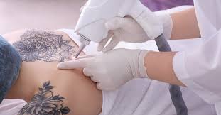 If you're second guessing one of your tattoos. Does Tattoo Removal Really Work Sdbotox Tattoo Removal