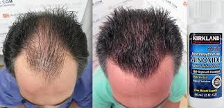 Minoxidil Venezuela Oficial Twitterren Recupera Tu Cabello Perdido Tambien Brindamos Consultas En Alopecia Androgenetica Whatsapp 58 412 249 29 81 Vikingfalcon Anticaida Crecepelo Calvicie Alopecia Kirkland Rogaine Minoxidil