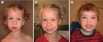 We did not find results for: A Subtle Familial Translocation T 3 21 P26 3 Q22 3 An Apparently Healthy Boy With A 3p Deletion And 21q Duplication Semantic Scholar