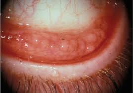 Image result for lesion sclera
