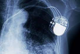 Последние твиты от pacemaker (@pacemaker). What Are The Side Effects Of Having A Pacemaker