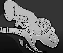 Image result for Brow Presentation