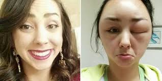 Symptoms of a hair dye allergy mild allergy is commonly characterized by skin inflammation in the scalp, eyelids, top of the ears, face, neck, chest or upper back. 24 Hair Dye Allergy Ideas Hair Dye Allergy Dyed Hair Hair