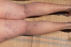 Treatment options include sclerotherapy (injections) and laser therapy, both which can make veins disappear. What Causes Spider Veins Naples Cardiac Endovascular Center