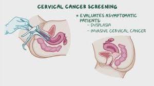 Image result for Cervical Cancer Screening