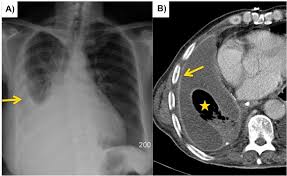 Detection of pleural effusion(s) and the creation of an initial differential diagnosis are highly dependent upon imaging of the pleural space. Epos Trade