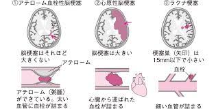 脳梗塞に関するq a 看護のための疾患ガイド 看護roo カンゴルー 看護ノート 看護 アテローム