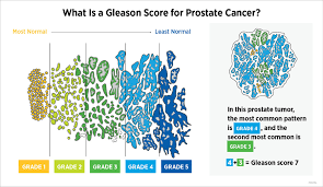 Image result for Prostate Cancer Histologic grading