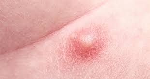 We did not find results for: Boils Abscesses
