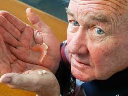 Man's teeth broken during gastroscopy