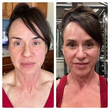 Face-lift and neck-lift results after 2.5 months