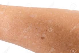Kleine Weisse Flecken An Den Armen Idiopathic Guttate Hypomelanosis Leberflecken Auf Der Haut Eines Alten Menschen Lizenzfreie Fotos Bilder Und Stock Fotografie Image 76627304