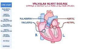 This restricts the flow of blood. Valvular Heart Disease Pathology Review Osmosis