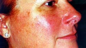 Image result for demodex rosacea
