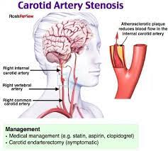 Carotid Artery Stenosis Pharmacology Nursing Medical School Essentials Medical Knowledge