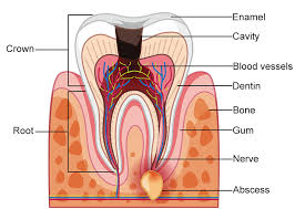 A gum abscess, also called a dental abscess, is the body's way of reacting to a gum infection. Tooth Abscess Healthdirect