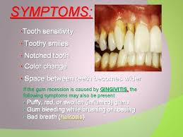 Gingivitis is an inflammation of the gums. Gingival Recession V Definition V Classification V Factors