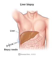 Liver biopsy